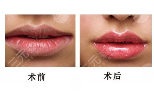 紋唇線果如何？紋唇線果能管多久？