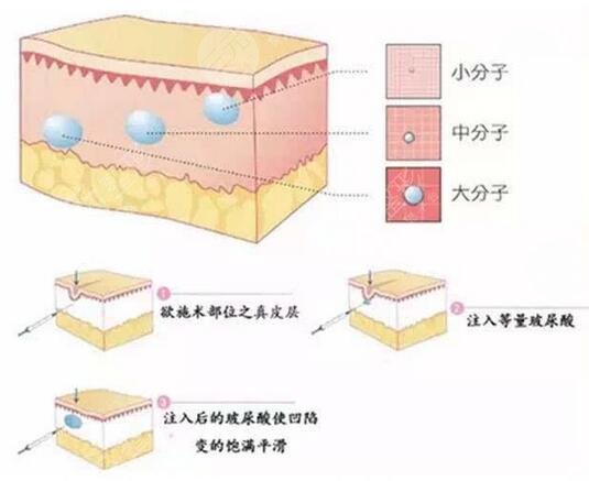 小分子玻尿酸可以打下巴嗎|小分子玻尿酸特點(diǎn)解析~