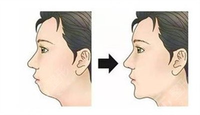 北京中諾第二口腔醫(yī)院牙齒矯正案例