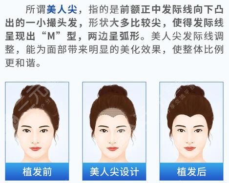 美人尖植發(fā)