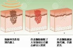 超激光美膚激光嫩膚多少錢？2022參考價格分享，掃黃美白心選擇！