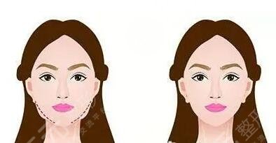 九院曹德君改臉型案例