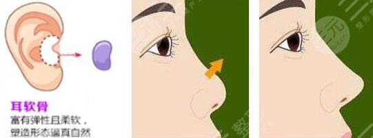 孫寶珊做鼻子案例果