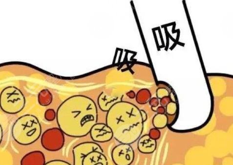 吸脂