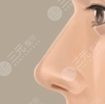 墊完鼻子的消腫過程圖十三天