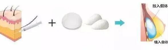 八大處楊慶華醫(yī)生隆胸案例