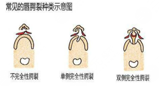 唇腭裂鼻子修復(fù)多大年齡合適？唇腭裂修復(fù)過程和時間需要多久？