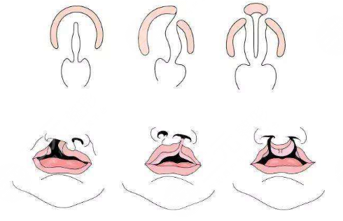 唇腭裂鼻子修復(fù)多大年齡合適？