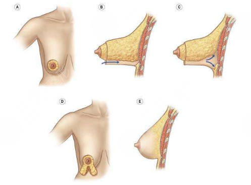 [做胸避雷]乳房懸吊術(shù)可以維持多久？有危險(xiǎn)嗎？術(shù)前準(zhǔn)備+術(shù)后護(hù)理盤點(diǎn)！