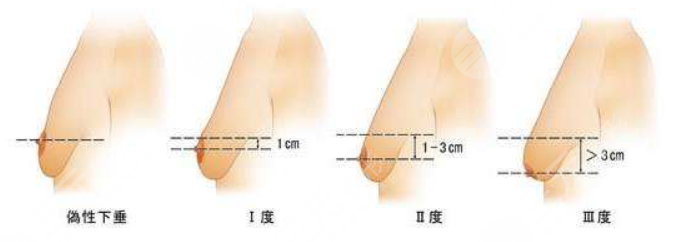 乳房懸吊術(shù)可以維持多久?