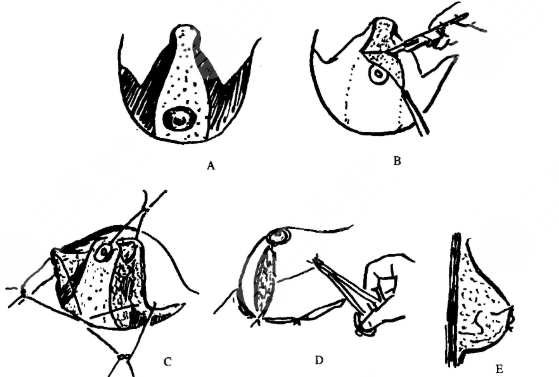 乳房懸吊術(shù)術(shù)前準(zhǔn)備工作