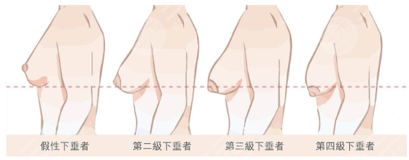 乳房懸吊術(shù)術(shù)后護(hù)理工作