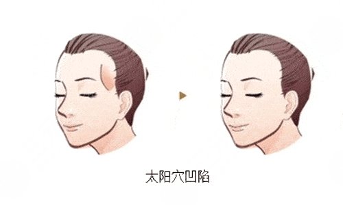 自體脂肪填充太陽凹陷能維持多久？多少錢？疼嗎？附價格表+注意事項