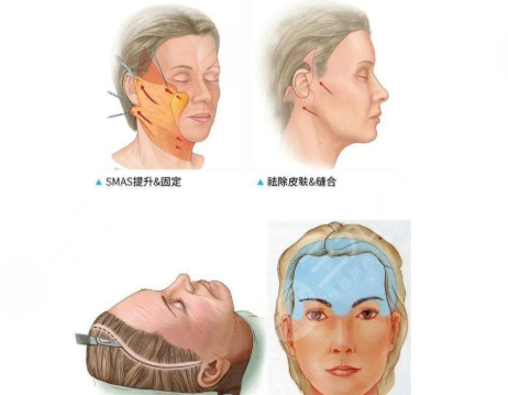 拉皮手術(shù)傷口會不會留疤？疤痕多久消失？手術(shù)注意事項30秒速讀