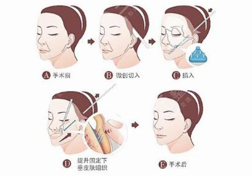 拉皮手術(shù)前注意事項