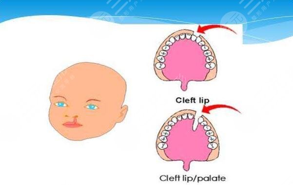 兔唇手術(shù)大概需要花費(fèi)多少元？