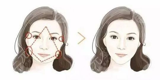 深圳非凡羅奇下頜骨整形