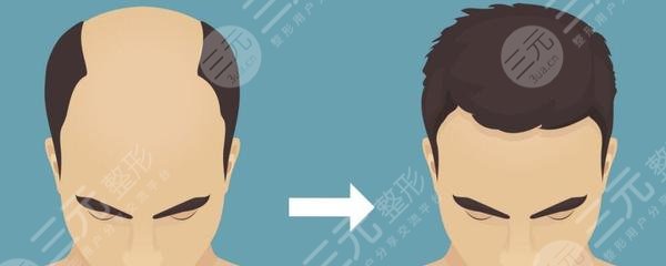 上海九院植發(fā)果圖