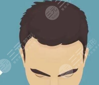 長(zhǎng)沙新生植發(fā)醫(yī)院胡須種植案例分享