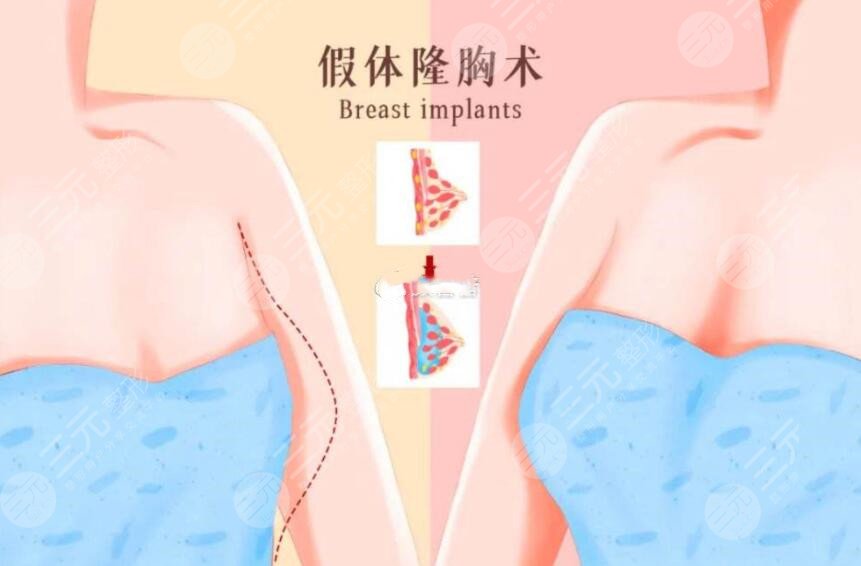 假體隆胸