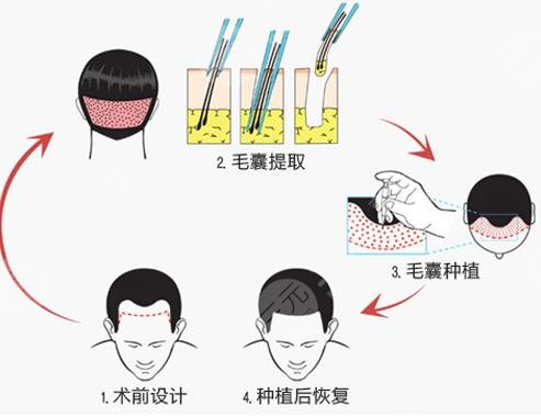 合肥叢生植發(fā)醫(yī)院禿頂植發(fā)案例分享