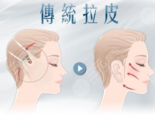 面部拉皮手術(shù)提升果和視頻
