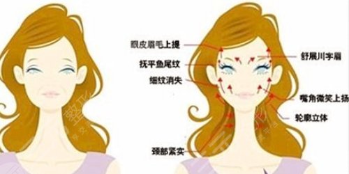 面部拉皮手術(shù)提升果和視頻賞析，多久能夠恢復(fù)？趕緊look