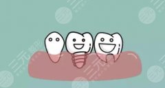 半口牙缺失好的緩解方案分享！牙齒種植讓你重新“笑口常開”！