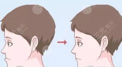 下頜前突手術(shù)危險(xiǎn)嗎？頜面整形必看科普！術(shù)前術(shù)后指南為你整理~