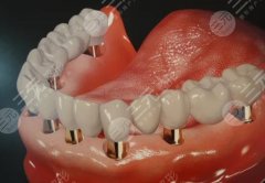 全口種植牙齒一般需要多少錢？價(jià)格表+口腔醫(yī)院分享，必備資料！