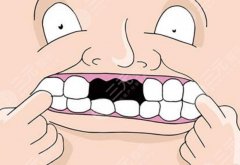 全口種植牙的利與弊，你知道多少？科普解答，助你再塑一口好牙！