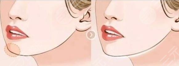 下巴填充