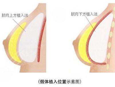 影響假體放置時(shí)間的因素