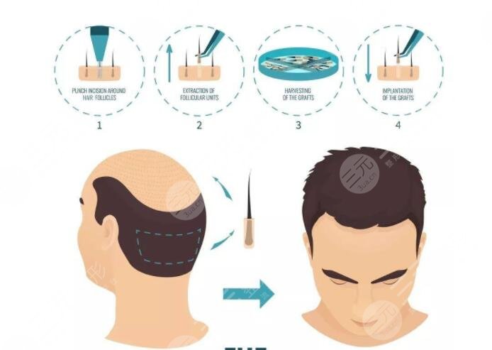 廣東省人民醫(yī)院植發(fā)項目科普