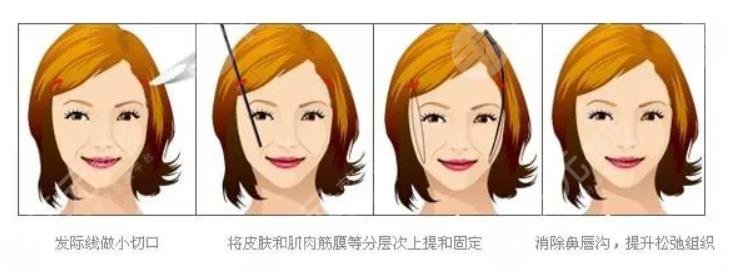 大拉皮手術(shù)15天照片