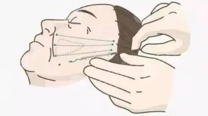 大拉皮手術(shù)15天照片