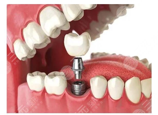 　牙齒種植體十大排名NO.9、?？怂狗N植體