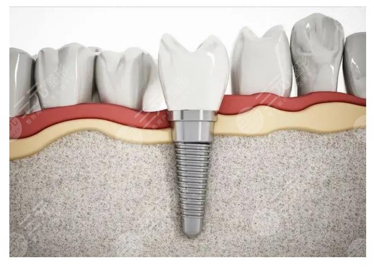 牙齒種植體十大排名+價格表！材質(zhì)等介紹，看看哪個好~