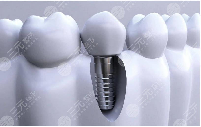 齒種植體十大排名NO.7、捷邁種植體