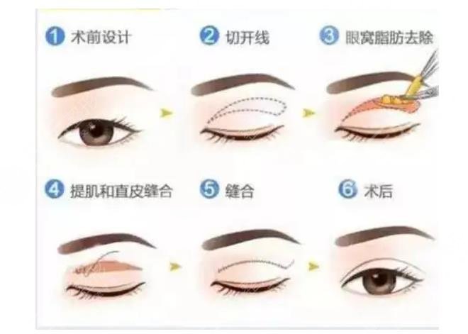 雙眼皮手術(shù)常見手法  　　1、埋線法