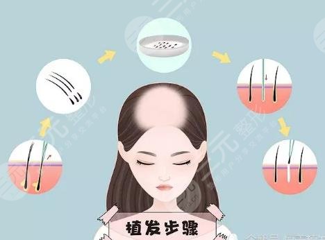 植發(fā)手術項目科普