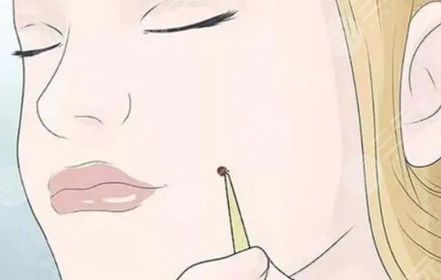 激光臉部點痣1到7天圖片恢復全過程，不再做“痣”女孩~