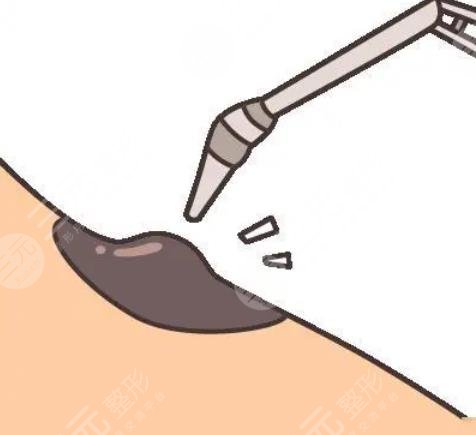 激光臉部點痣1到7天圖片恢復全過程，不再做“痣”女孩~