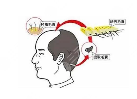 頭發(fā)種植項(xiàng)目科普