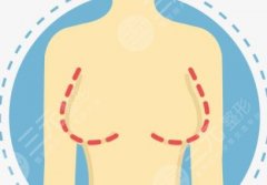 傲諾拉隆胸后需要按摩嗎？假體隆胸C位材料，術(shù)后貼心指南！