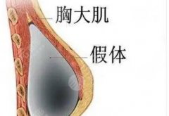 北京假體隆胸價格多少錢？新費(fèi)用均價參考，美胸不花冤枉錢！