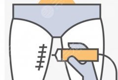 體雕溶脂能持續(xù)多久，果怎么樣？美體塑形新方式，科普帶你了解！