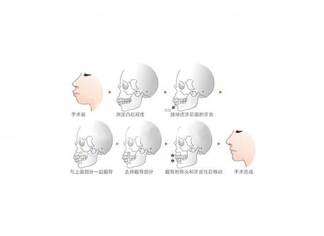 番禺中心醫(yī)院口腔科牙齒矯正案例|網(wǎng)友親身經(jīng)歷:術(shù)前