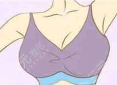 法芮婭跟傲諾拉的區(qū)別在哪里？科普，進(jìn)口假體隆胸“天花板”之爭！