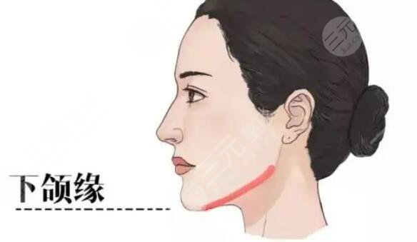 熱瑪吉下頜緣緊致提升